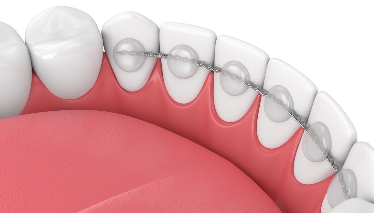 La période de contention orthodontique